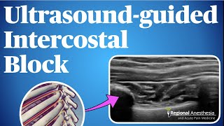 UltrasoundGuided Intercostal Nerve Block [upl. by Tomkins]