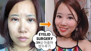 I did double eyelid surgery in Korea incl 30 days recovery process pics amp vids [upl. by Alleram]