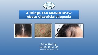 Cicatricial Alopecia 3 things you should know with Jennifer Krejci MD [upl. by Blatt]