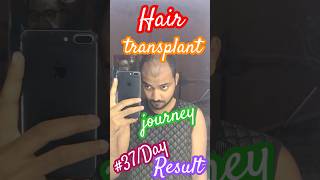 37day result hair transplant journey Comment Reply viralreelsinstagram video viralyoutuber [upl. by Hulton631]