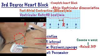 AV Heart Block  First degree heart Block  Mobitz type1  Mobitz type2  Complete heart Block [upl. by Anyotal559]