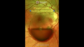 Macular preretinal hemorrhage Valsalva retinopathy [upl. by Hardej94]