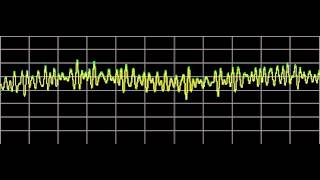 Hemangioma  Rife Frequencies [upl. by Fleta]