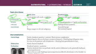 Peptic Ulcer Disease  USMLE STEP 1 [upl. by Cthrine521]