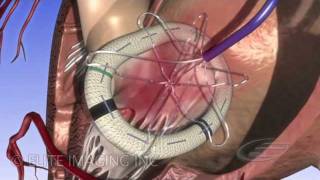 Mitral Heart Valve Ring  Medical amp Scientific Video Production [upl. by Ainat845]