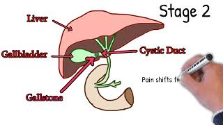 Cholecystitis  Symptoms Causes Treatment How to Detect Cholecystitis Merphy sign Explained Easy [upl. by Aihtela]