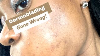 My First DermabladingDermaplaning Experience  How I Repaired My Skin Barrier in Five Weeks [upl. by Sesilu640]