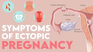 HEAVY SIGNS And SYMPTOMS Of ECTOPIC Pregnancy MOMMATTERS [upl. by Dlarrej206]