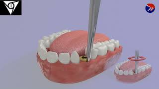 M1 Atraumatic ankylosed root extraction using pre elevator 1 [upl. by Marela]