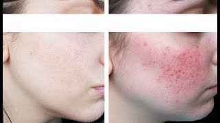 Tout sur ma Rosacée  Kératose pilaire  Session Laser  Dr Charbonneau [upl. by Noiztneb]