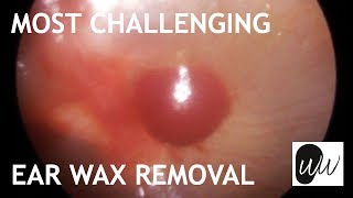 My Most Challenging Ear Wax Removal Yet  395 [upl. by Krishna945]