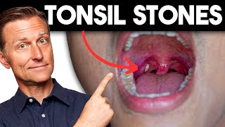 Tonsil Stones Removing the Deeper Cause [upl. by Angelle]