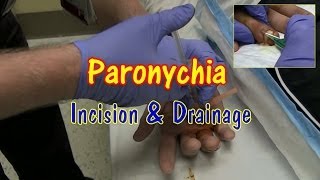 Paronychia Incision and Drainage [upl. by Narot350]