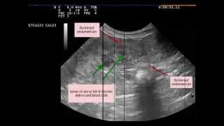 Endometritis not pyometra dog [upl. by Laira529]