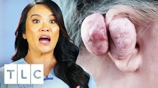 Dr Lee Removes 14 Oz Keloid From Womans Ear  Dr Pimple Popper [upl. by Ambie]