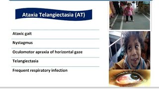 Ataxia Telangiectasia  Spot Diagnosis  12  Pediatrics [upl. by Yenalem]