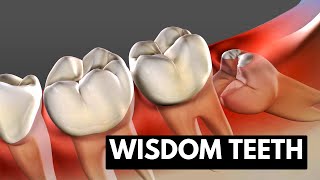 Wisdom teeth Causes Symptoms and Treatment [upl. by Hannavahs969]