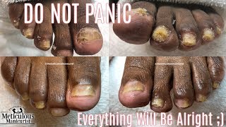 Pedicure Miraculous Before amp After Nail Fungus Toenail Cleaning [upl. by Alfredo]