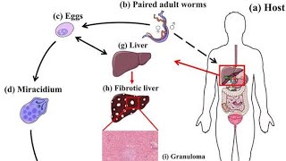 Effects of Schistosomiasis on the Liver  Hepatic schistosomiasis  Causes symptoms diagnosis pre [upl. by Adnirual145]