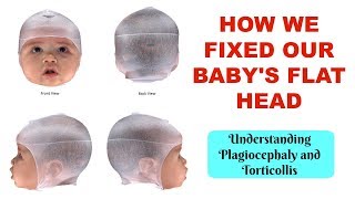 HOW TO TREAT AND PREVENT A BABYS FLAT HEAD  Understanding Plagiocephaly and Torticollis [upl. by Walther754]