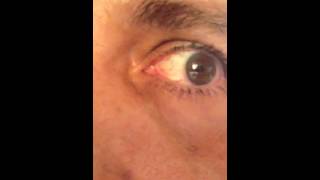 Eye lens flicker after Cataract Surgery 3 Dysphotopsia [upl. by Keller]