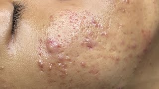 ACNE TREATMENT VU QUYNH MI  Perennial Blackheads On Boy Face 2024FULL [upl. by Tsew]