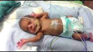 Babys nose got damaged in NICU due to hospital negligence [upl. by Braunstein]