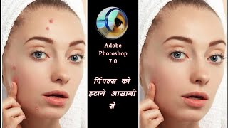 Pimples Ko kaise Hataye  How To Remove Pimples In Photoshop [upl. by Loeb]