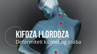 Deformacija kičmenog stuba II Deo  Kifoza i lordoza kako je otkriti i vežbe [upl. by Upshaw]