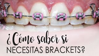 ¿CÓMO SABES SI NECESITAS BRACKETS  CASOS QUE NECESITAN ORTODONCIA [upl. by Nodnorb]