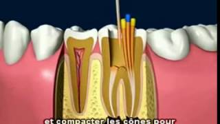 Le traitement de canal dentaire Clinique Dentaire Orozen [upl. by Fredette]