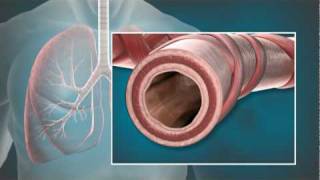 Animation of Bronchial Thermoplasty BT with the Alair® System [upl. by Ttreve220]