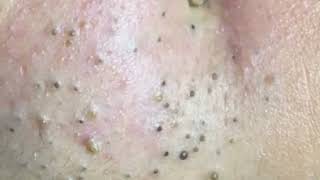 how to remove blackheads from forehead at home  blackheads white  how to remove small pimples [upl. by Ardra]