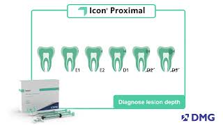 Icon Proximal Steps for Treatment [upl. by Ahsek105]