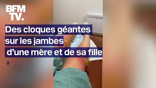 Des cloques géantes apparaissent sur les jambes d’une mère et de sa fille après une sortie au lac [upl. by Teddi]