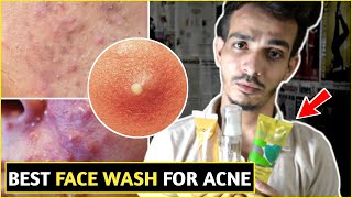 Top 3 Face Wash To Remove Acne Pimples With Salicylic Acid and Glycolic Acid [upl. by Akihdar433]