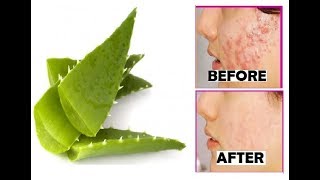 Remove acne and pimples overnight  aloe vera and toothpaste beauty hacks [upl. by Cookie]