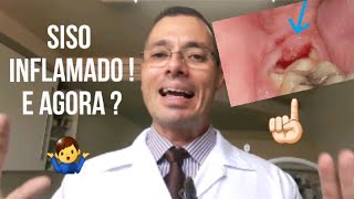 DENTE SISO INFLAMADO O que fazer [upl. by Teplitz]