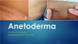 ANETODERMA BY DR ABRAHAM dermatology scarystory skincareeducation funny ANETODERMA [upl. by Skippy158]