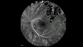 Fluorescein Angiography of the Left Eye at Baseline and at 3Year FollowUp [upl. by Kerwin466]