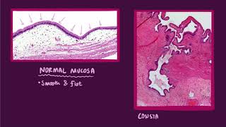 Chronic cholecystitis causes symptoms diagnosis treatment amp pathology [upl. by Annodam]