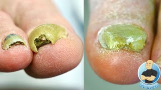 CUTTING AND TRIMMING SUPER THICK TOENAILS HOW TO MANAGE HARD TO CUT TOENAILS [upl. by Garlen]