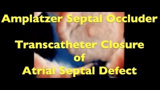 Amplatzer Septal Occluder Large Atrial Septal Defect [upl. by Artined642]