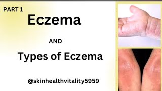 Eczema and its types by skin specialistchambal ki types dermatitis ‎skinhealthvitality5959 [upl. by Simaj]