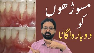 How to Rebuild Gums to Cure Gum Recession [upl. by Hiller755]