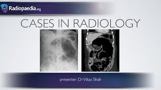 Cases in Radiology Episode 6 abdominal emergency xray CT [upl. by Yrellih]