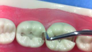 99 Second Tips  Class II Composite to Amalgam Prep Conversion [upl. by Aridatha577]