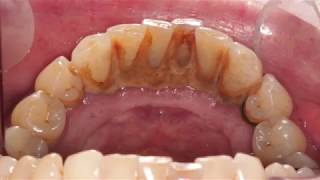 Before and After Scale and Polish  Dental Hygienist Telford [upl. by Wrightson958]