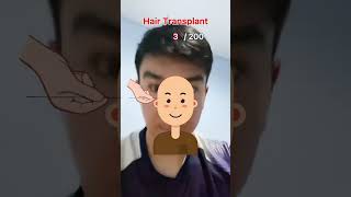 Hair transplant stickman animation [upl. by Pinchas526]