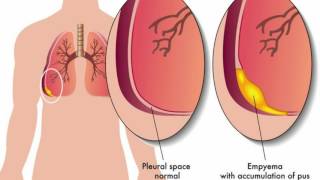 Cardiac Ultrasound Pericardial vs Pleural effusion [upl. by Annoyek363]